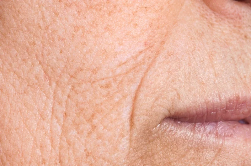 Peeling de Fenol: Uma solução para suavizar linhas de expressão.