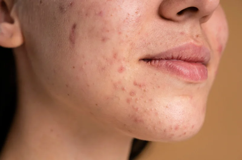 Microagulhamento com Drug Delivery para cicatrizes de acne.