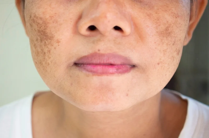 Peeling para melasma: Uma solução para manchas indesejadas.